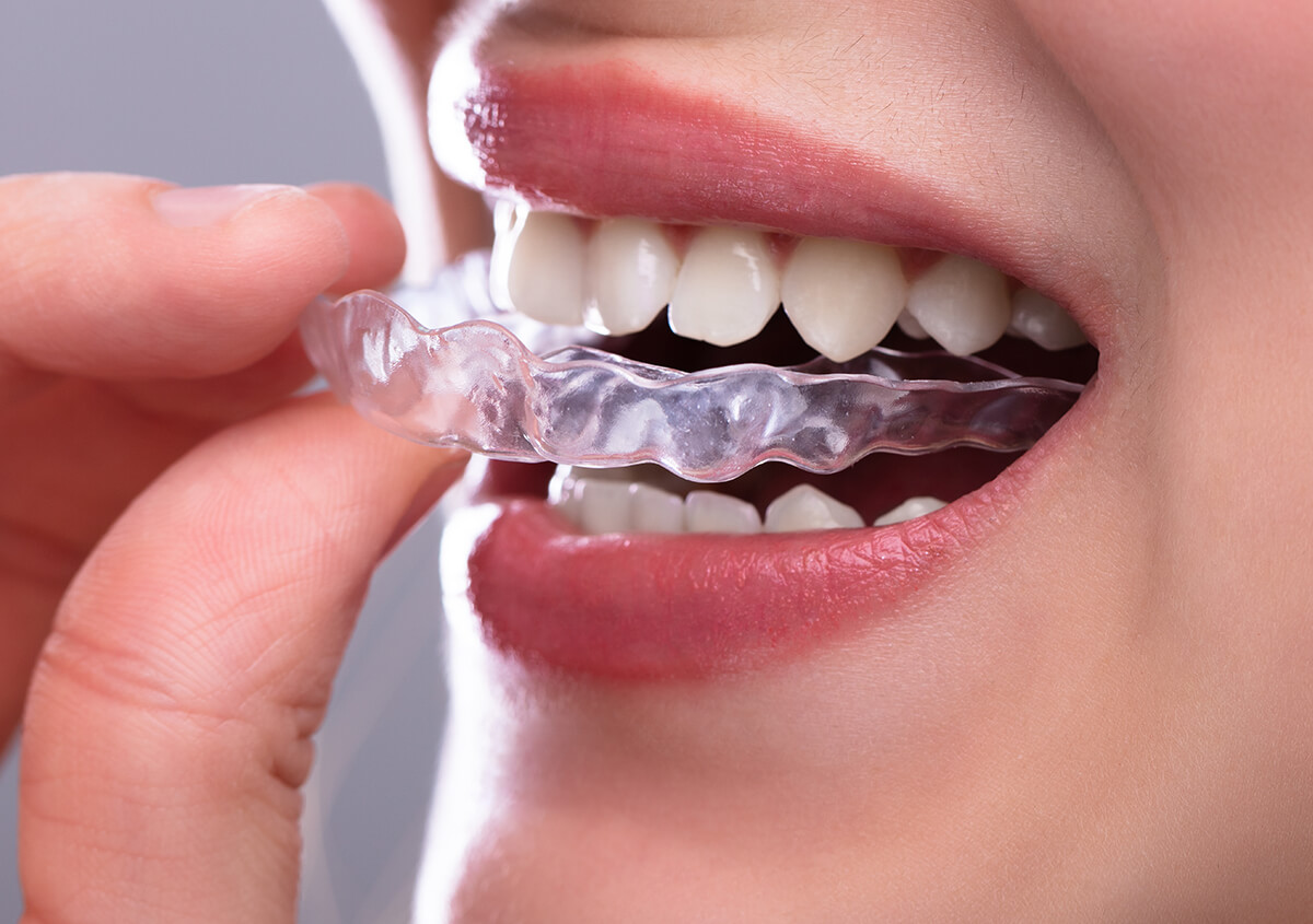 Invisalign Teeth Straightening in Willoughby OH Area