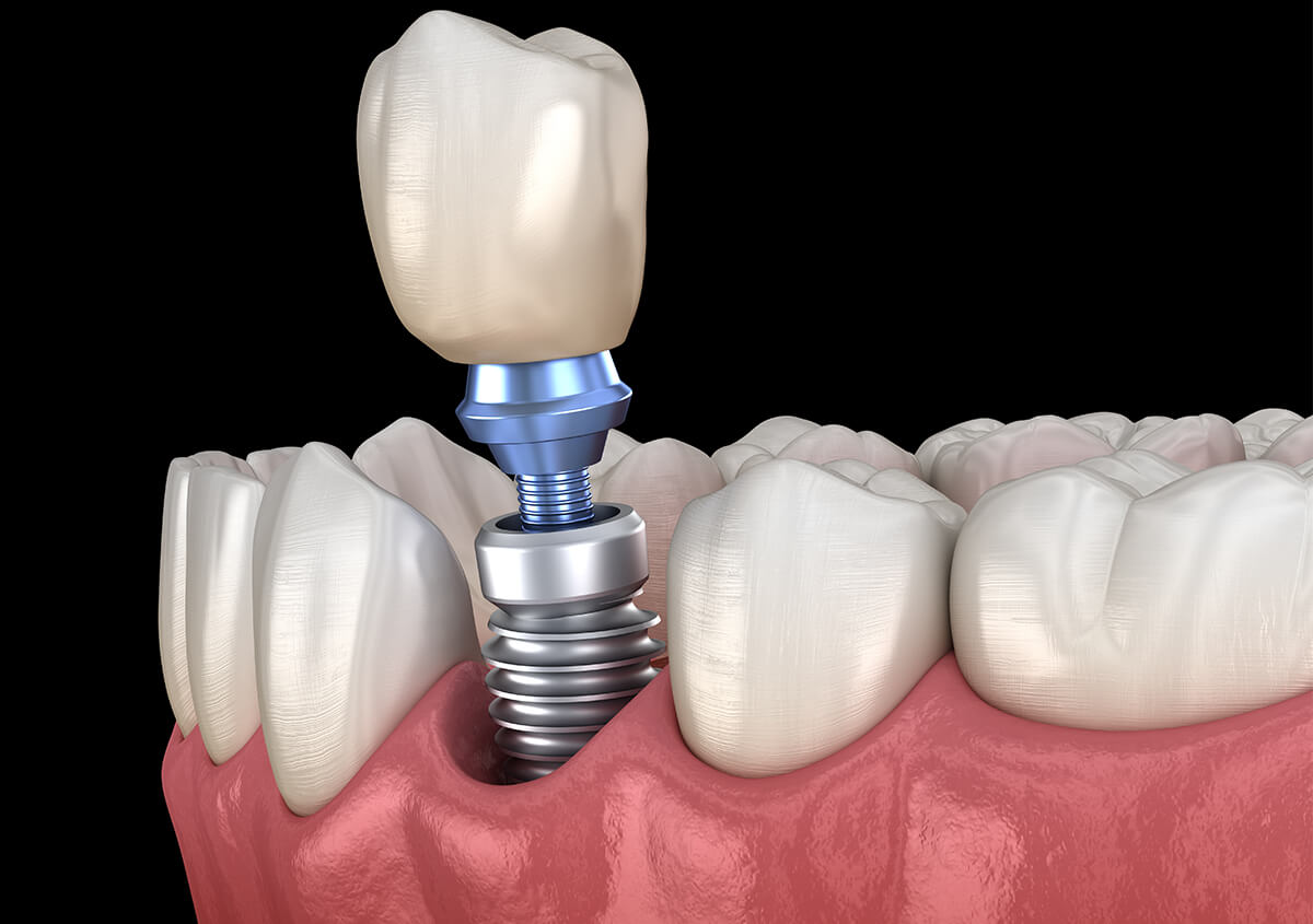 Dental Implants Procedure in Willoughby OH Area