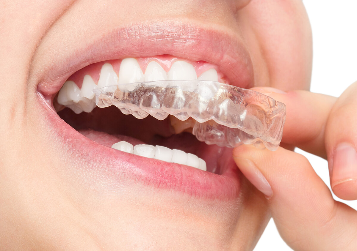 Invisalign for Teeth in Willoughby OH Area