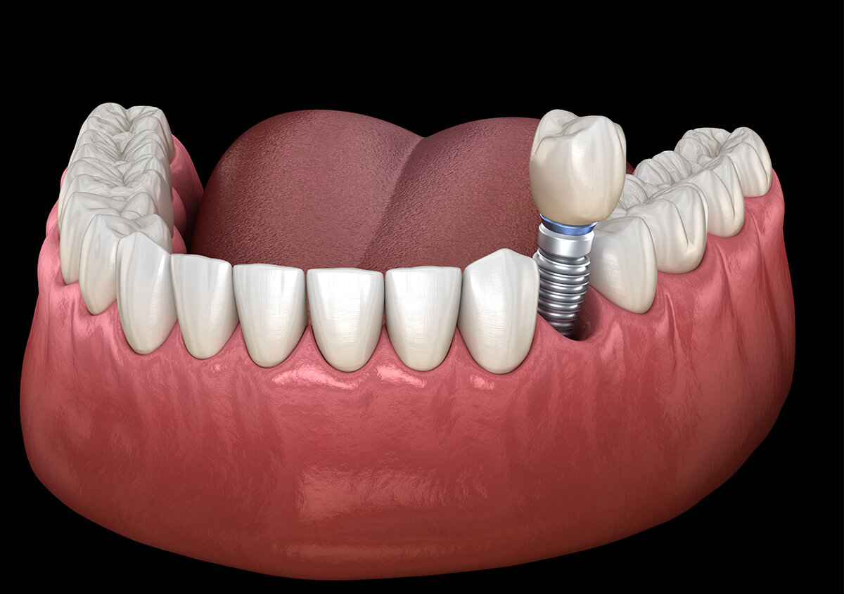 Getting Dental Implants in Willoughby OH Area